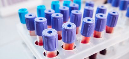 NIPT-test: hoe zit het met de vergoeding?